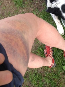 bruise from bike crash may 2014