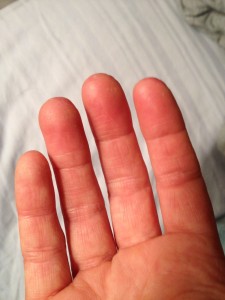 I test my blood sugar 8 to 12 times a day. Can you see the calluses on my fingertips?