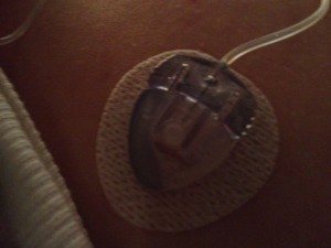 I change my pump infusion site every 3 days. This is where it is on me today. 