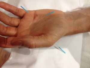 left hand with needles