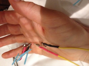 right hand with needles and stim